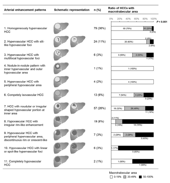 MRI의 동맥기 조영 증강 패턴 (arterial enhancement pattern)에 따른 macrotrabecular area의 비교 분석