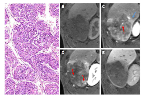 Macrotrabecular-massive HCC(MTM-HCC) 의 전형적인 MRI 영상 소견