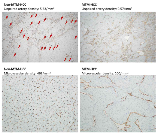 Unpaired artery와 microvascular density의 정량화