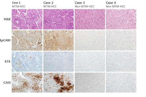 Macrotrabecular-massive HCC 여부에 따른 CAIX, K19, EpCAM의 발현 비교