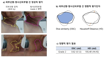 방사선피부염 예측 정확도에 대한 정성적/정량적 평가