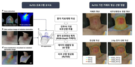 개발한 RaTES의 모식도 및 실제 환자에의 적용 예시