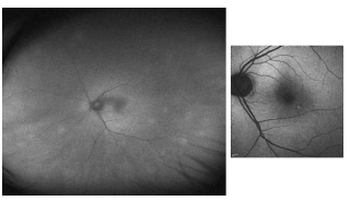 AMD 환자에서 커큐민 3개월간 복용 후 시행한 AF imaging에서 뚜렷한 과형광 spot이 관찰되지 않음
