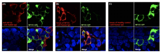 Neurofascin-155 항체 측정 cell-based assay. GFP가 tagging된 human recombinant NF155를 HEK293세포에 transfection하여 HEK293세포막에 NF155를 발현시켰음 (녹색형광). A. Alexa Fluor 594(적색 형광)가 붙어있는 polyclonal anti-NF155 항체를 반응시켰을 때 녹색형광이 발현되어 있는 세포막을 따라 적 색형광이 함께 발현되는 세포들이 확인됨. B. NF155양성 환자의 혈청을 반응시켰을 때 녹색과 적색형광이 함께 발현되는 세포가 확인됨. C. 건강인의 혈청을 적용하였을 때에는 적색형광은 관찰되지 않고 세포막을 따라 녹색 형광의 발현만 관찰되었음