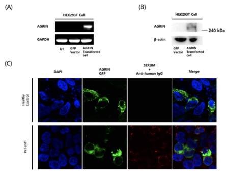 Agrin항체 측정 cell basedassay. (A) Agrin을 transfection한 HEK293세포에서 LRP4 mRNA의 발현을 rt-PCR로 확인함. (B) Agrin을 transfection한 HEK293세포에서 agrin protein의 발현을 western blot으로 확인함. (C) Agrin을 transfection한 HEK293세포에 중증 근무력증환자와 건강인의 혈청을 적 용하여 Agrin항체 양성 중증근무력증 환자의 혈청을 적용하였을 때 Agrin 의 발현위치(녹색형광)와 Agrin항체 (적색형광)이 위치가 일치함을 확인하여 Agrin항체 양성을 확인함
