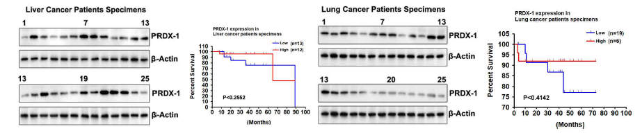 Levels of peroxiredoxin 1 in liver and lunf cancer patient tissues