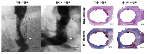 코팅하지 않은 기존 스텐트와 은나노 입자를 코팅한 스텐트의 비교