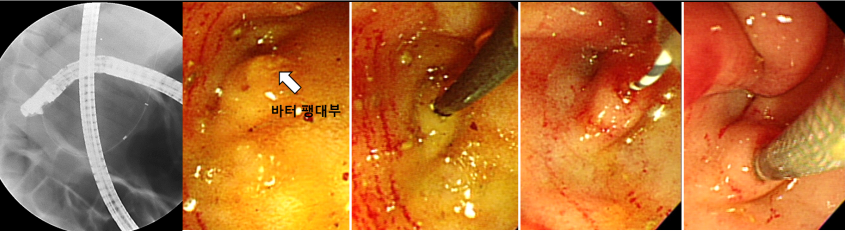 내시경 유도하에 돼지 담도에 고주파 소작용 스텐트 삽입