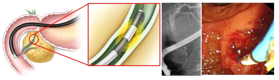 내시경 유도하 담관 내 고주파 소작술