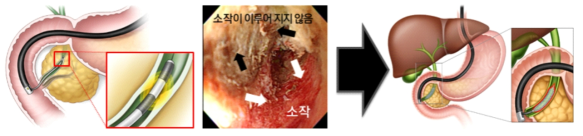 균일한 열전달이 가능 및 소작 범위를 조절할 수 있는 고주파 소작용 스텐트 개발전략