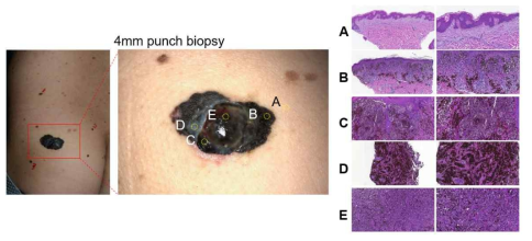 선천성 멜라닌세포 모반에서 흑색종이 발생한 환자의 병변에서 5개의 multi-region biopsy를 시행함