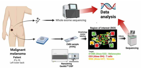 Multi-region whole exome sequencing을 진행하였고, 이후 excision 검체로 Spatial transcriptomics를 수행함