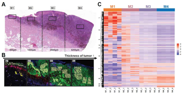 Tumor thickness가 증가함에 따라 서로 다른 조직학적 특성을 보이는 cell cluster에서 gene expression pattern도 차이를 보이는 것을 확인함. A-B. Excision sample에서 Tumor Thickness에 따라 M1부터 M4까지 네 개의 area를 나눔. C. M1-M4에서 gene expression pattern에 유의미한 차이를 보임