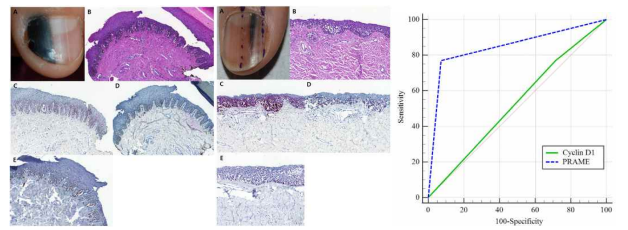PRAME에 대한 면역조직화학염색이 양성 멜라닌 세포 병변과 흑색종의 진단에 도움이 됨