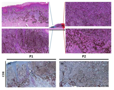 Tissue slide를 invasion depth에 따라 P1 (superficial invasion), P2 (deep invasion) 두 영역으로 나눔. 조직소견을 보면 P1에서는 tumor nest 주변으로 prominent한 lymphocyte와 macrophage infiltration이 관찰됨. P2에서는 tumor thickness가 증가함에 따라 tumor cell nest 주변으로 macrophage infiltration이 주로 관찰되었고, lymphocyte infiltration은 적음. Tumor가 P1에서 P2로 진행할 때 tumor infiltrating CD8 T cell이 감소함