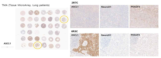 Tumor MicroArray를 이용한 폐암환자들의 subtype 염색조건 확인