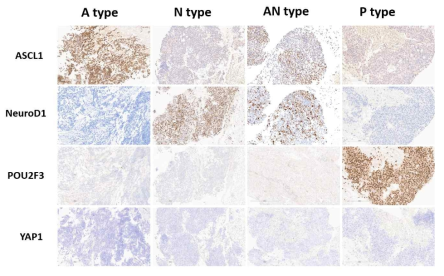 IHC를 이용한 SCLC subtyping