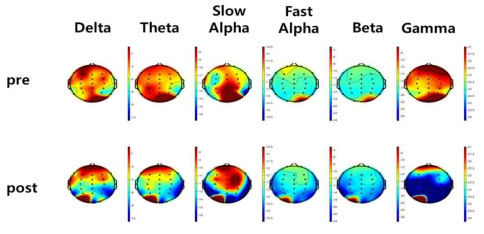 알츠하이머 환자의 치료 전(위)과 후(아래) EEG데이터 시각화. 청색, 녹색, 적색 순으로 EEG 주파수의 상대적인 파워가 높아짐. 치료 후 델타, 세타, 감마파가 전반적으로 감소하고 slow, fast 알파, 베타파 모두 증가함