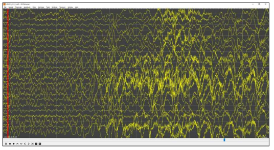 CHB-MIT 오픈 데이터셋의 소아 뇌전증 환자의 발작 시 뇌파, 정상인의 뇌파와는 달리 뇌파가 비정상적으로 뇌 전반에 걸쳐서 과활성화되어 있는 것을 볼 수 있음 (빨간선: 간질 발작 시작 시점)