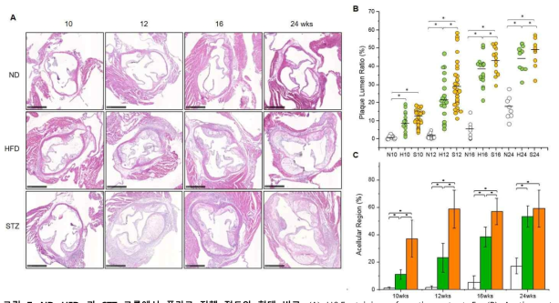 ND, HFD, 과 STZ 그룹에서 플라크 진행 정도와 형태 비교. (A) H&E staining of aortic root at 5x (B) Aortic root plaque/lumen ratio (C) Acellular (necrotic) region percentage. *P < 0.05 vs ND, #P < 0.05 vs HFD