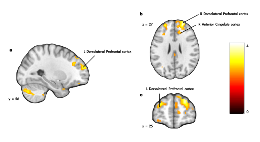 a. 금연클리닉 이전 과제 수행시 Pavlovian incongruent 조건에서 금연 성공 집단의 활성화가 금연 실패 집단에 비해 크게 나타난 영역. b, c. 금연클리닉 이전 과제 수행시 보상과 관련한 Pavlovian incongruent 조건에서 금연 성공 집단의 활성화가 금연 실패 집단에 비해 크게 나타난 영역. Color bar: t-value