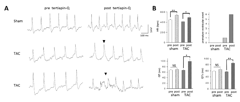 Effects of tertiapin-Q, a specific GIRK channel blocker on the mice model of heart failure. A. Representative trace of sham and hear failure mice induced by TAC. B. summarized data for heart rate (HR), QT, QTc, premature ventricular event of sham and TAC mcie before and after TTQ treatment