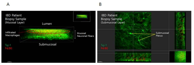 (A)신경 마커(tuj-1)와 대식세포 마커 (F4/80)으로 염색하여 공초점 현미경으로 관찰한 인체유래물 (B) 염증성장질환 환자 인체유래물에서의 대식세포의 침윤 부위와 주면 장내신경섬유의 실질 구조