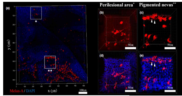 (a) 색소성 모반 표피의 멜라닌세포 3차원 이미지. (b, c) 단일 채널로 자른 멜라닌세포 이미지 (X, Y = 133. 18 ㎛). (d, e) 3D 분석 프로그램 정량화를 위한 재구성 이미지. (c, e) 색소성 모반 영역은 주변부 (b, d)에 비해 멜라닌세포 세포체의 수가 증가하고 가지돌기의 길이가 연장되었음. 색소성 모반 영역 일부의 멜라닌세포는 세포 분열 과정을 보여줌 (white arrowhead). Red = Melan-A positive melanocyte)