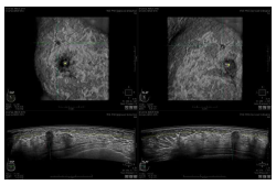 ABUS에서 발견된 유방암의 예: 관상단면 (Coronal 영상, 상부)에서 병변을 클릭하면 해당병면의 가로 세로의 단면영상 (하부)을 확인할 수 있다