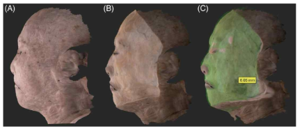 3D 스캔을 통한 피부층별 깊이 변화