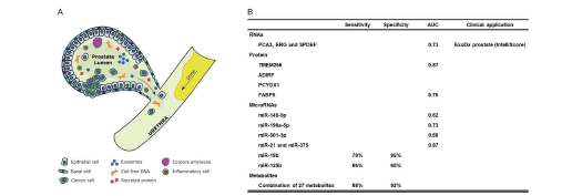 소변 내 전립선 분비물 (A) 및 소변 엑소좀을 이용한 전립선암 바이오마커 연구 (B)
