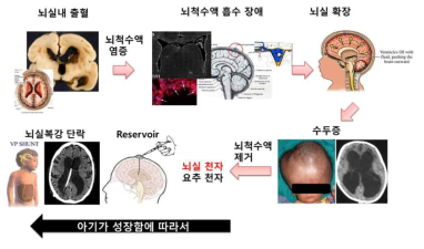 미숙아 뇌실내 출혈의 진행 경과