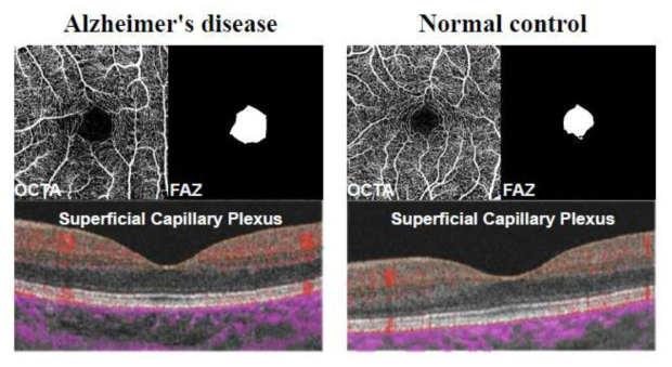알츠하이머 환자와 정상군의 OCTA 영상에서의 FAZ