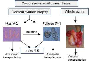 현재 시행중인 조기난소부전 환자의 치료방법