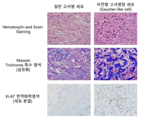 비전형적 고셔병 환자 병리 소견