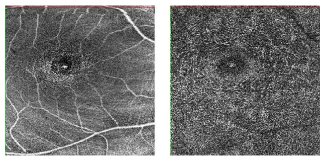 망막의 이미지를 통한 layer마다 혈관 분포 및 조직 특성까지 구별 가능