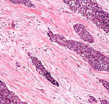 종양내 림프구가 관찰 되지 않는 췌장암 조직 소견.