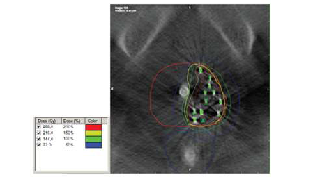 Note: Computed tomography (contours of the prostate in red, target in yellow, rectum in blue. 100%, 150%, and 200% isodose lines in green, yellow, and red). The green triangles and circles indicate seed positions