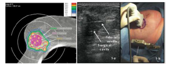 Dose distribution analysis performed 2 months after the implant of Pd-103 seeds