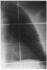 Anterior-posterior radiograph with Pd-103