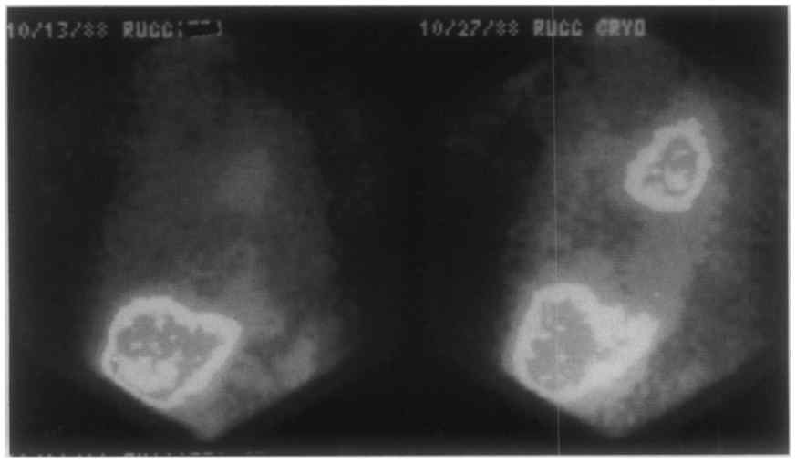 Tumoral uptake of radiolabeled BLM before cryotherapy, and 15 days later, after the cryotherapy procedure