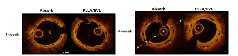 각 실험군의 대포 OCT 사진. 심혈관 중재용 융해성 고분자 융합지지체 이식 초기(1주), 후기(4주) OCT 이미지. PLLA: poly-L-lactic acid, EVL: everolimus