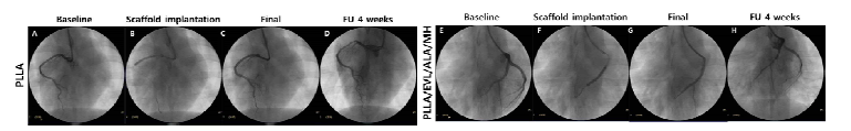 심혈관 조영술을 통한 심혈관 중재용 융해성 고분자 융합지지체 이식 과정 이미지. (A, E) 관상동맥의 baseline 조영술 이미지, (B, F) 풍선 카테터를 이용한 심혈관 중재용 융해성 고분자 융합지지체 이식 이미지, (C, G) 지지체 이식 직후 조영술 이미지 및 (D, H) 지지체 이식 4주 후 최종 조영술 이미지