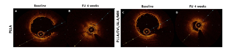 심혈관 중재용 융해성 고분자 융합지지체의 이식 4주 후 OCT 이미지 (A, C) 관상 동맥내 심혈관 중재용 융해성 고분자 융합지지체 이식 직후 OCT 이미지 및 (B, D) 지지체 이식 4주 후 OCT 이미지