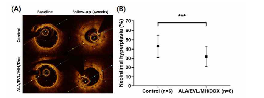심혈관 중재용 융해성 고분자 융합지지체의 이식. 관상동맥 내 심혈관 중재용 융해성 고분자 융합지지체 이식 직후, (A) 이식 4주 후 OCT 대표 사진 및 (B) 지지체 이식 4주 후 스트러트 주변 신생내막 증식율