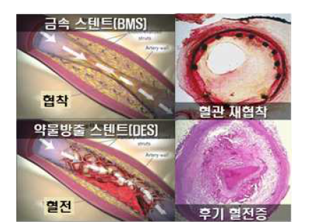 심혈관 관상동맥 스텐트의 문제점