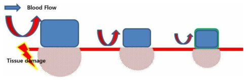 스트러트의 크기에 따른 혈류 와류 형성 및 관상동맥 내 조직 손상