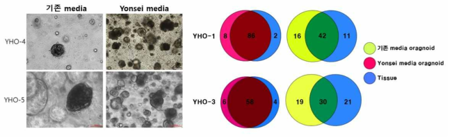 간세포암 오가노이드 수립률 및 암 purity 확인. 본 연구자 그룹에서 기존 media 조성을 변형하여 수립한 간암 환자 조직 유래 오가노이드와 기존 논문(Nat Med 2017;23:1424-35)의 방법대로 수립한 오가노이드의 수립률 및 암세포 purity 비교(왼쪽)와 gene signature pattern 비교(오른쪽)를 통해 연구자 그룹의 오가노이드가 원조직과의 유사성 및 인체 재현성 측면에서 우수함을 입증