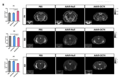 OCT4 치료 9주후, MRI 결과(target region : Corpus Callosum)