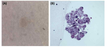 Collagen I을 활용한 in vitro granuloma model 구축